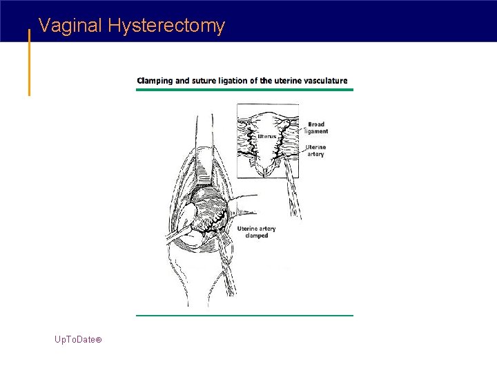 Vaginal Hysterectomy Up. To. Date® 