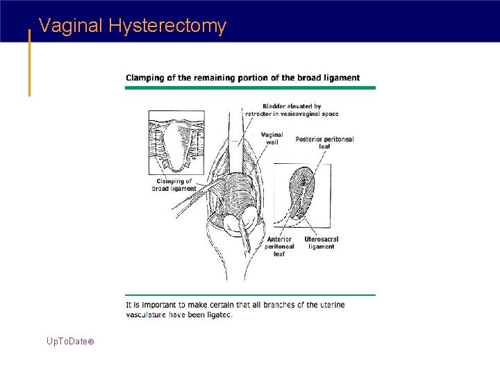 Vaginal Hysterectomy Up. To. Date® 