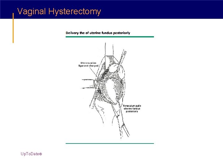 Vaginal Hysterectomy Up. To. Date® Vaginal Hysterectomy Up. To. Date®