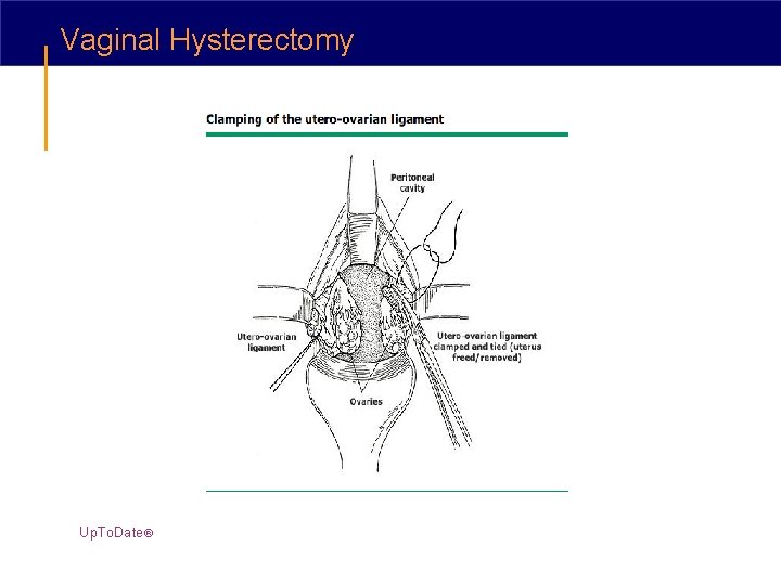 Vaginal Hysterectomy Up. To. Date® 