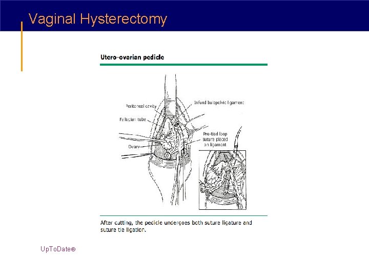 Vaginal Hysterectomy Up. To. Date® 