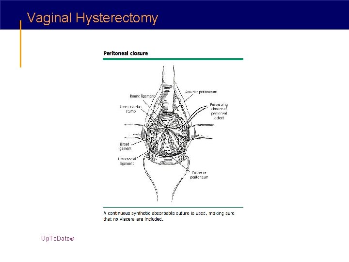 Vaginal Hysterectomy Up. To. Date® 