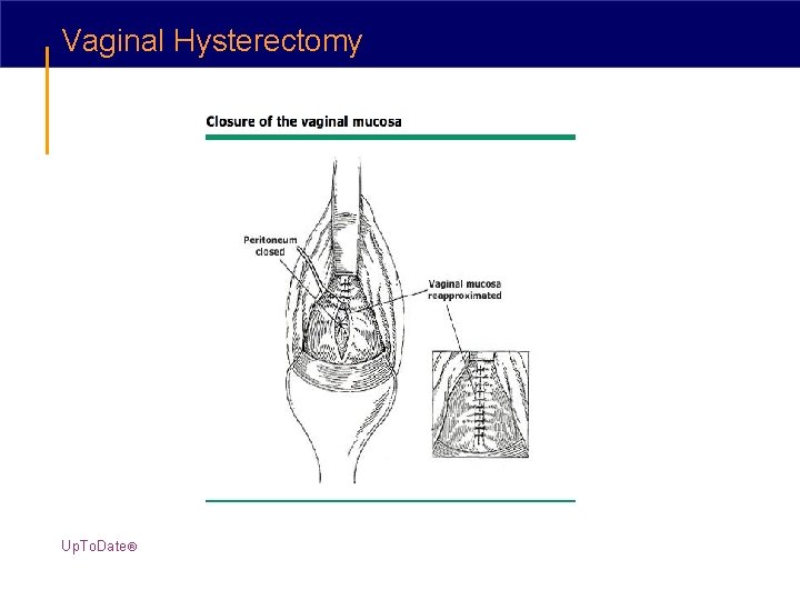 Vaginal Hysterectomy Up. To. Date® 