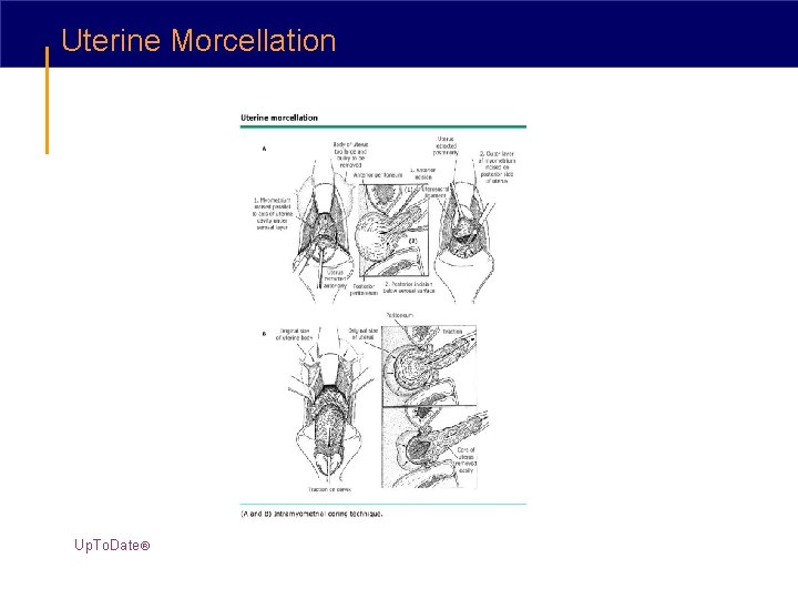 Uterine Morcellation Up. To. Date® 