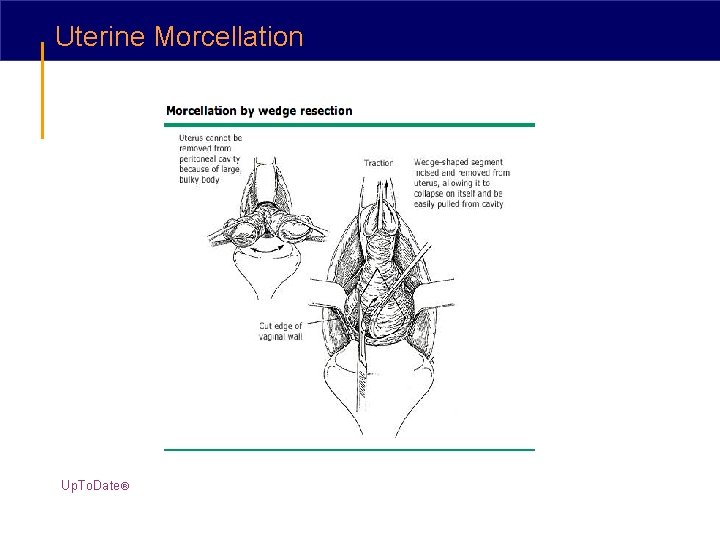 Uterine Morcellation Up. To. Date® 
