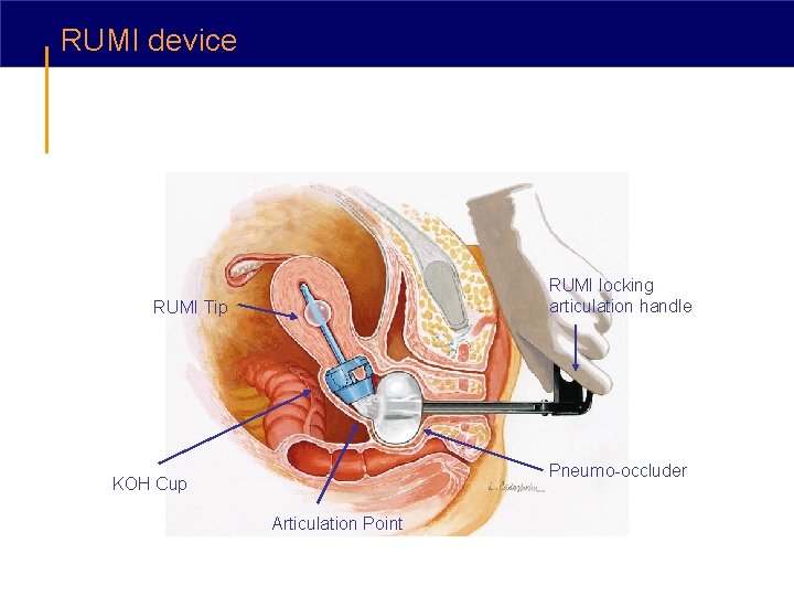 RUMI device RUMI locking articulation handle RUMI Tip Pneumo-occluder KOH Cup Articulation Point 