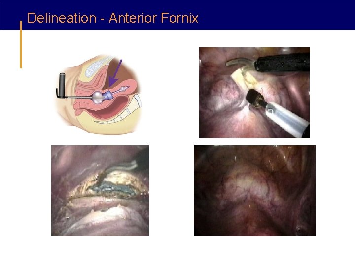 Delineation - Anterior Fornix 