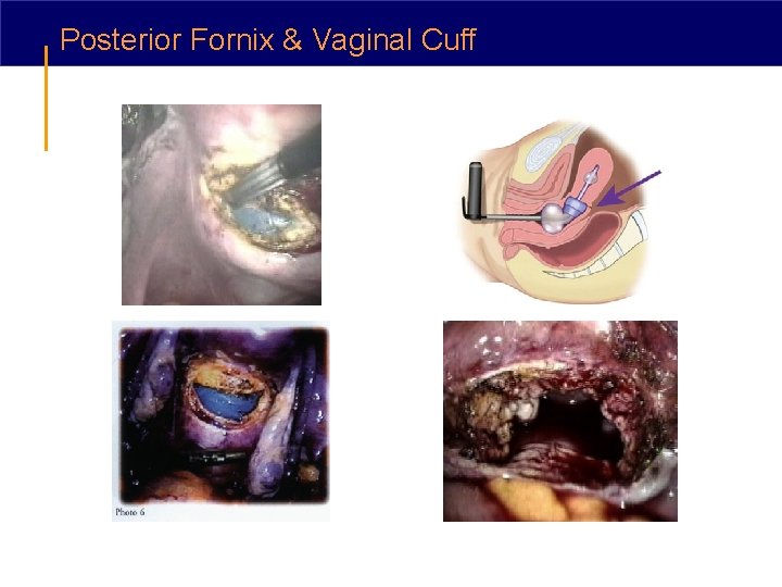 Posterior Fornix & Vaginal Cuff 