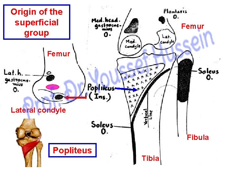 Origin of the superficial group Femur Lateral condyle Fibula Popliteus Tibia 