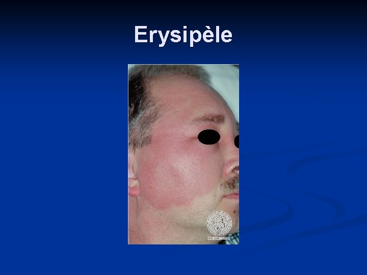 Erysipèle 