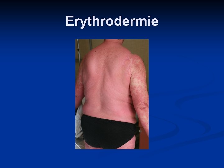 Erythrodermie 