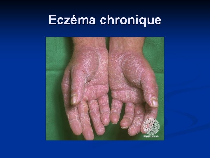 Eczéma chronique 