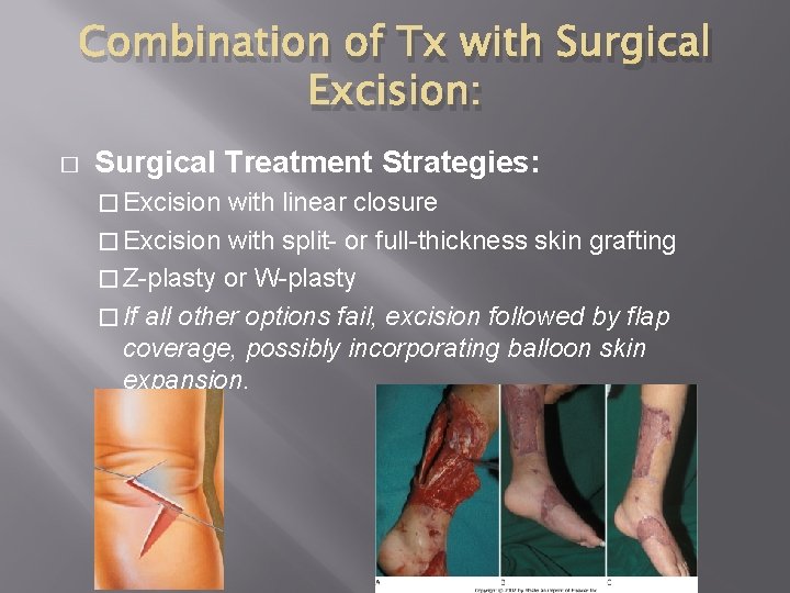 Combination of Tx with Surgical Excision: � Surgical Treatment Strategies: � Excision with linear