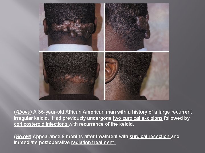 (Above) A 35 -year-old African American man with a history of a large recurrent