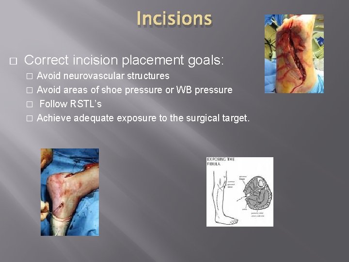 Incisions � Correct incision placement goals: Avoid neurovascular structures � Avoid areas of shoe