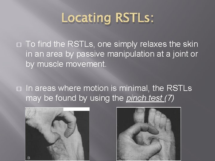 Locating RSTLs: � To find the RSTLs, one simply relaxes the skin in an