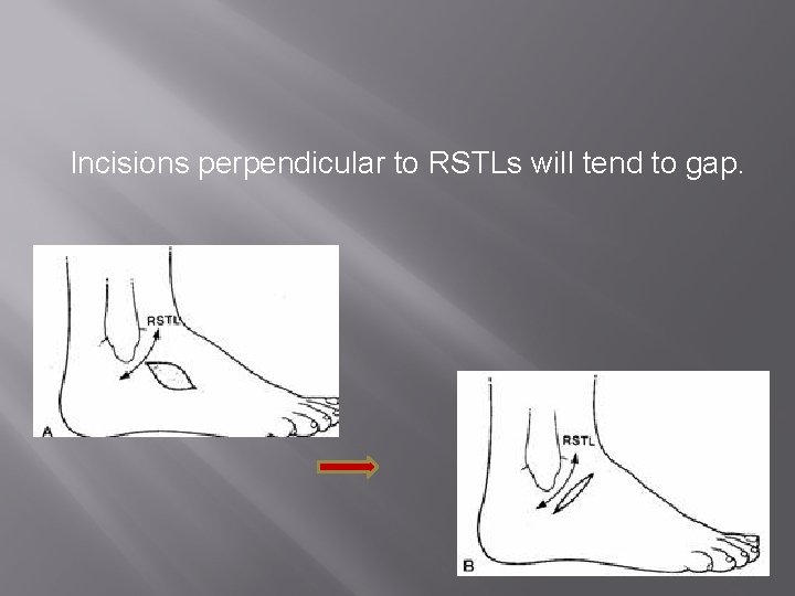 Incisions perpendicular to RSTLs will tend to gap. 