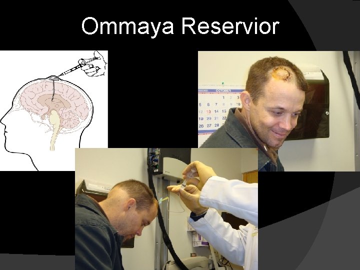 Ommaya Reservior 