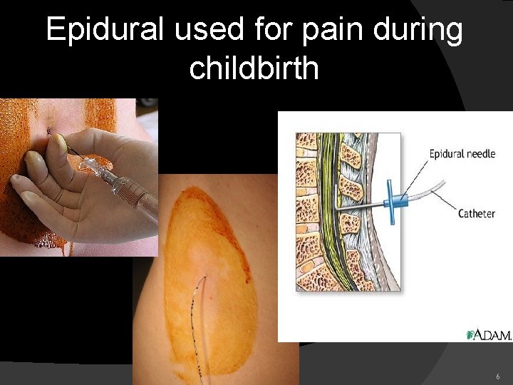 Epidural used for pain during childbirth 6 