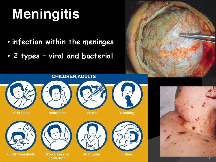 Meningitis • infection within the meninges • 2 types – viral and bacterial 7