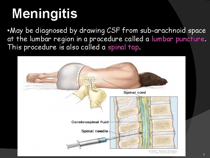 Meningitis • May be diagnosed by drawing CSF from sub-arachnoid space at the lumbar