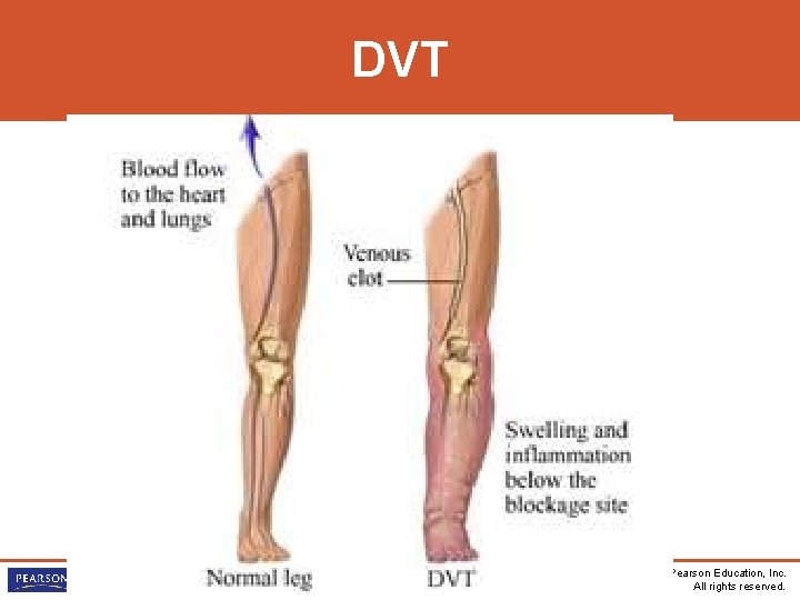 DVT Medical-Surgical Nursing Care, Third Edition Burke • Mohn-Brown • Eby Copyright © 2011