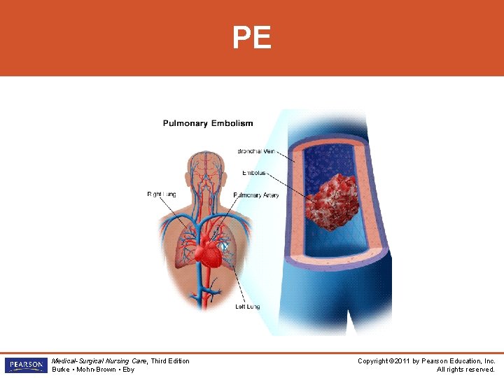 PE Medical-Surgical Nursing Care, Third Edition Burke • Mohn-Brown • Eby Copyright © 2011