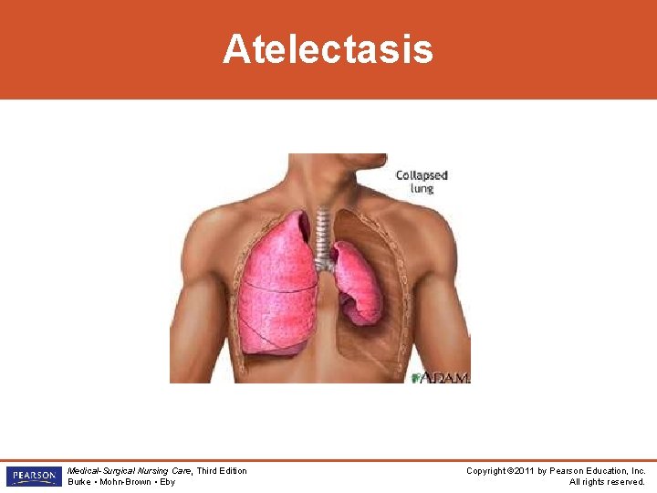 Atelectasis Medical-Surgical Nursing Care, Third Edition Burke • Mohn-Brown • Eby Copyright © 2011