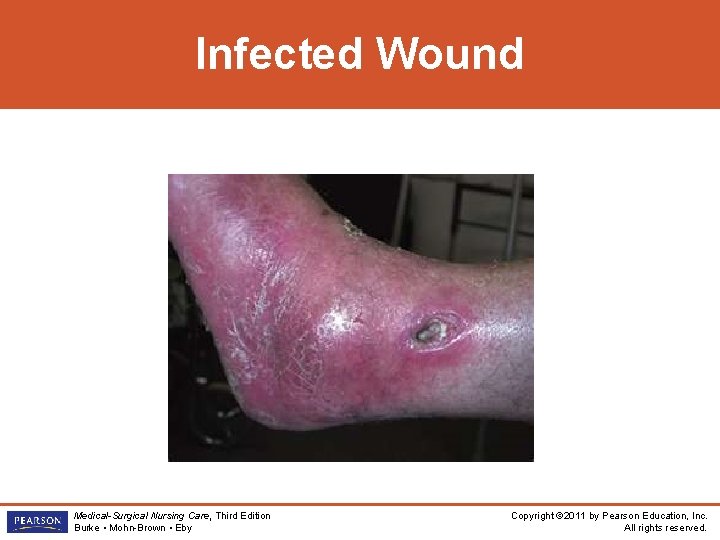 Infected Wound Medical-Surgical Nursing Care, Third Edition Burke • Mohn-Brown • Eby Copyright ©