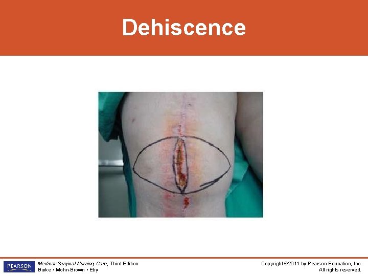 Dehiscence Medical-Surgical Nursing Care, Third Edition Burke • Mohn-Brown • Eby Copyright © 2011