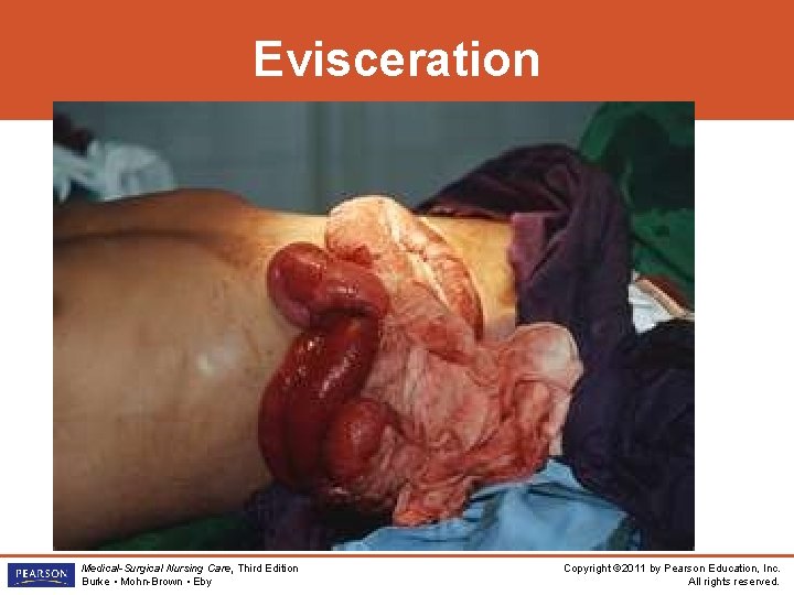 Evisceration Medical-Surgical Nursing Care, Third Edition Burke • Mohn-Brown • Eby Copyright © 2011