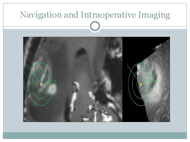 Navigation and Intraoperative Imaging 