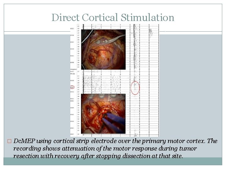 Direct Cortical Stimulation � Dc. MEP using cortical strip electrode over the primary motor