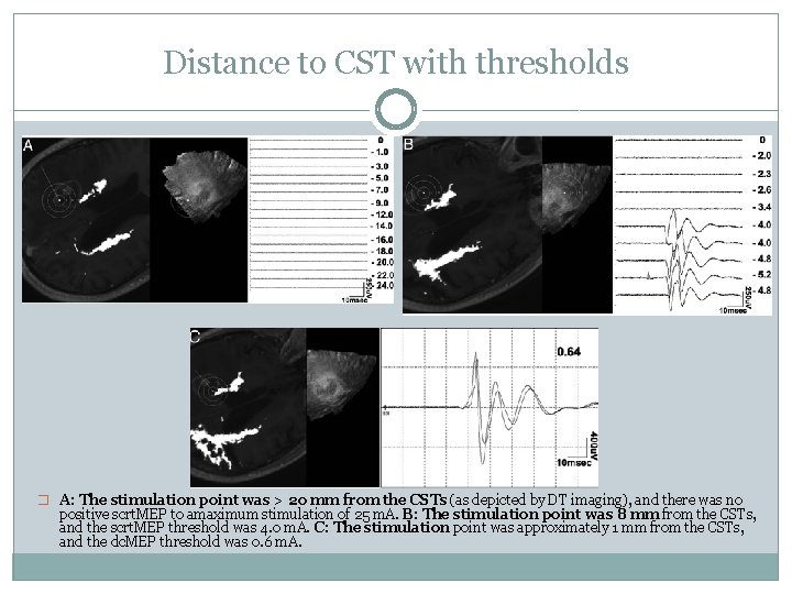 Distance to CST with thresholds � A: The stimulation point was > 20 mm