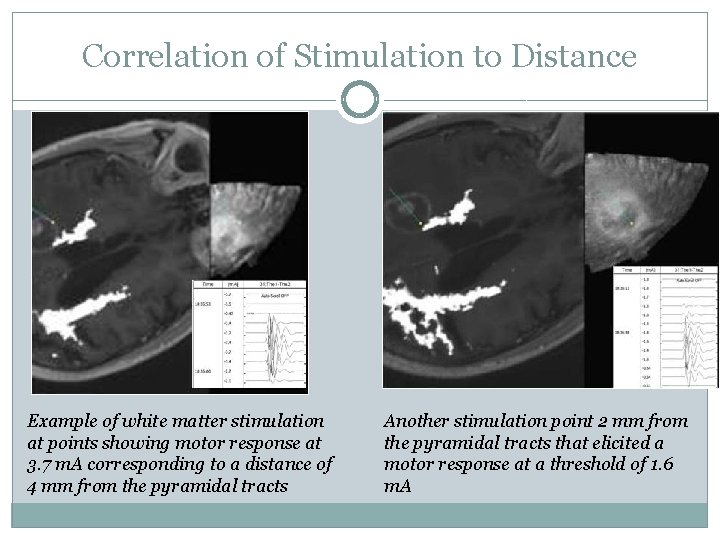 Correlation of Stimulation to Distance Example of white matter stimulation at points showing motor
