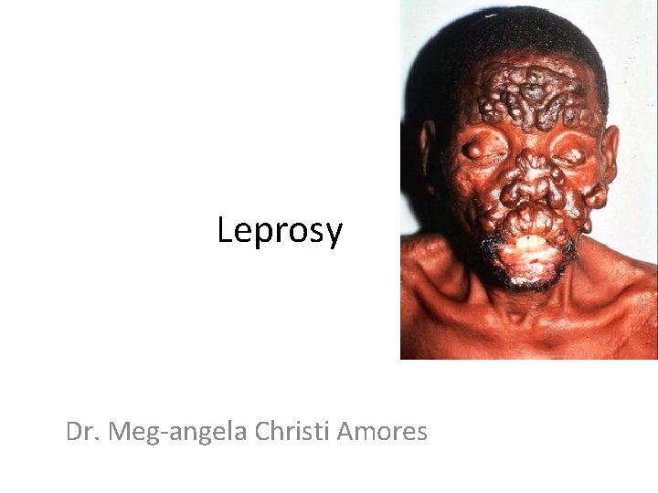 Leprosy Dr. Meg-angela Christi Amores 