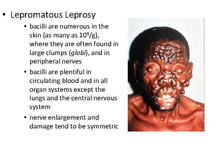  • Lepromatous Leprosy • bacilli are numerous in the skin (as many as