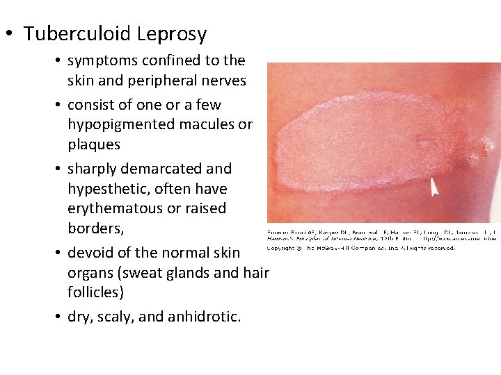  • Tuberculoid Leprosy • symptoms confined to the skin and peripheral nerves •