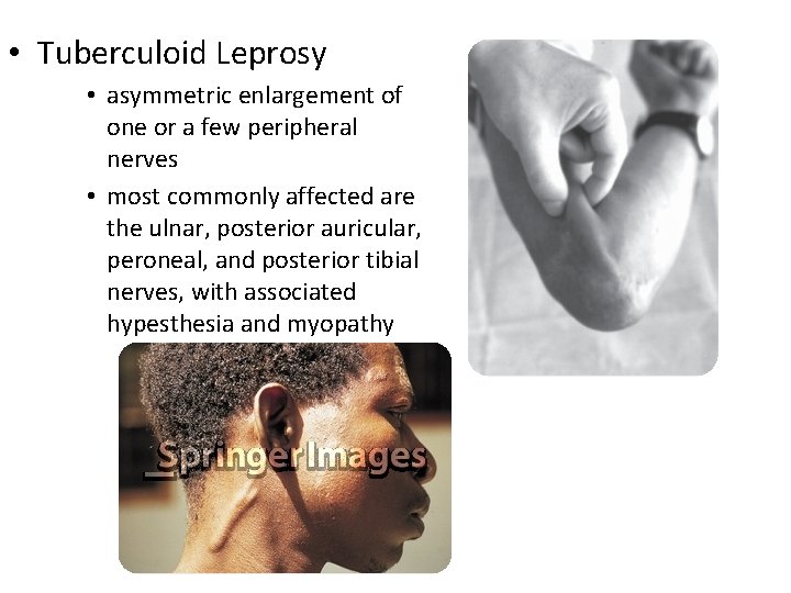  • Tuberculoid Leprosy • asymmetric enlargement of one or a few peripheral nerves