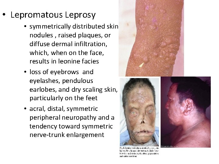  • Lepromatous Leprosy • symmetrically distributed skin nodules , raised plaques, or diffuse