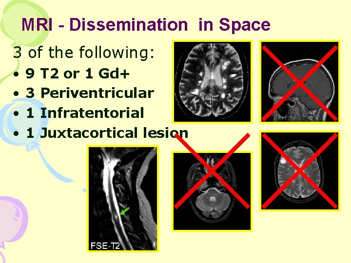 MRI - Dissemination in Space 3 of the following: • • 9 3 1