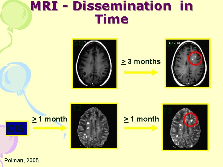 MRI - Dissemination in Time Gd Gd > 3 months T 2 CIS >