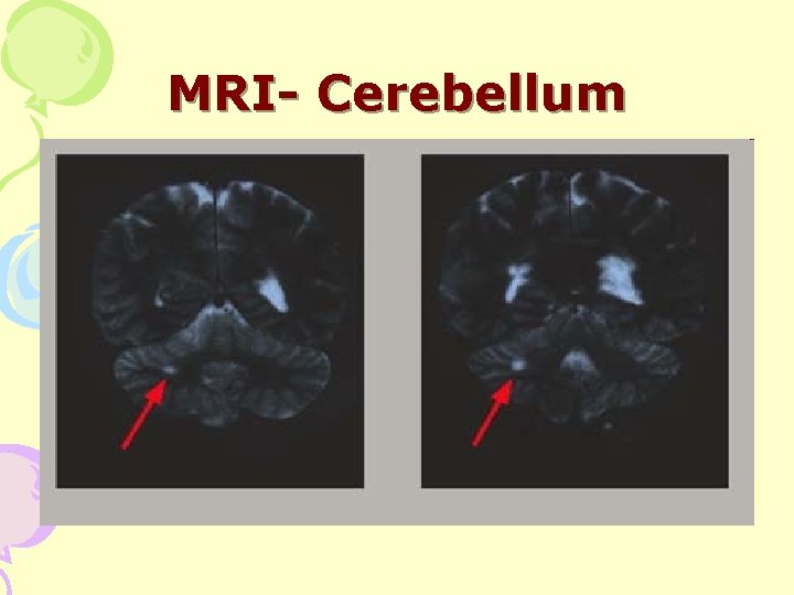 MRI- Cerebellum 