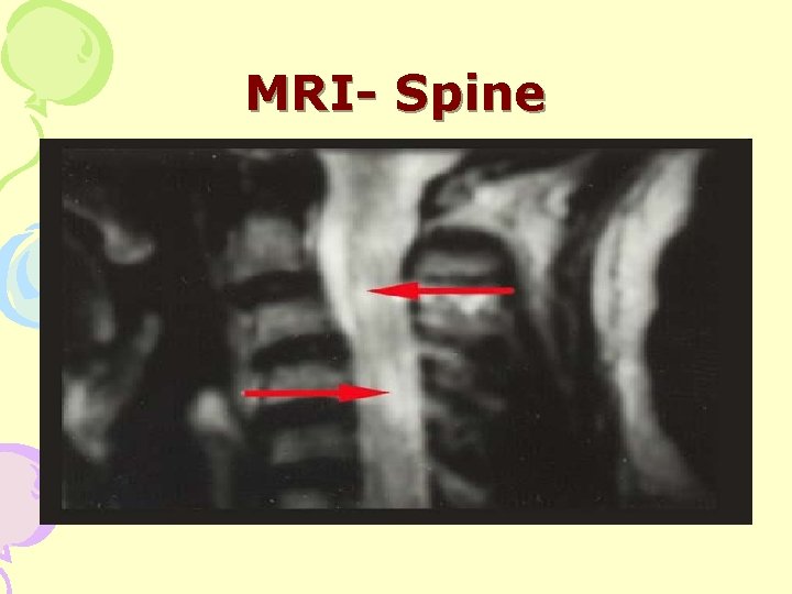 MRI- Spine 
