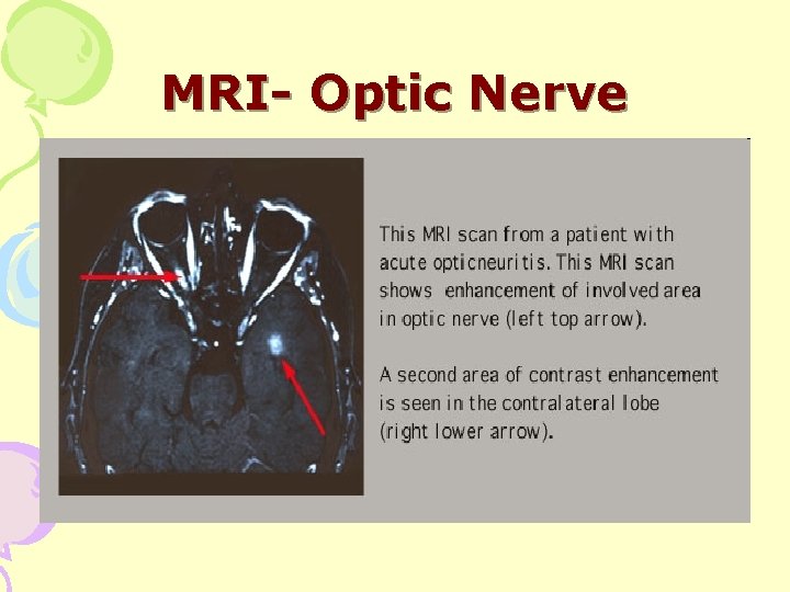 MRI- Optic Nerve 