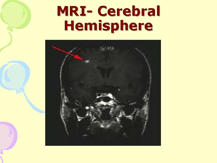 MRI- Cerebral Hemisphere 