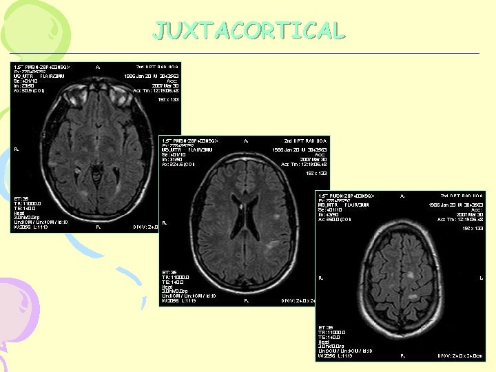 JUXTACORTICAL 