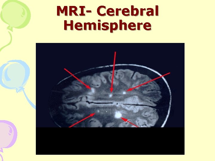 MRI- Cerebral Hemisphere 