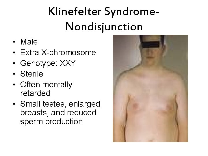 Klinefelter Syndrome. Nondisjunction • • • Male Extra X-chromosome Genotype: XXY Sterile Often mentally