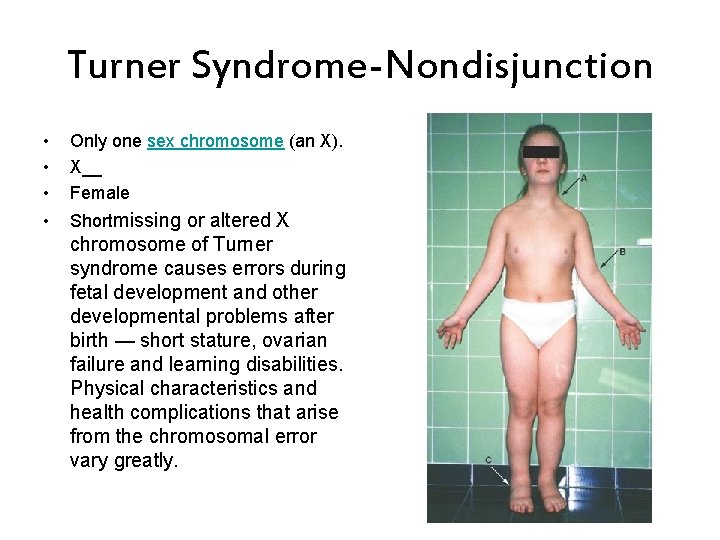 Turner Syndrome-Nondisjunction • • • Only one sex chromosome (an X). X__ Female •